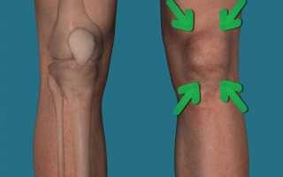 Артрит коленного сустава: как вылечить артрит колена