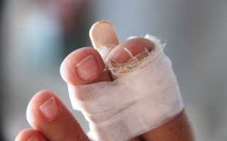 Причины боли в суставе большого пальца на ноге