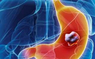 Степени и лечение недифференцированного рака желудка