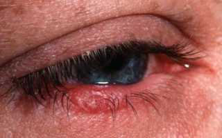 Почему возникает блефароконъюнктивит глаз и его лечение в домашних условиях?
