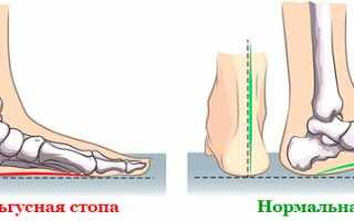 Вальгусная деформация стопы у детей: последствия и исправление