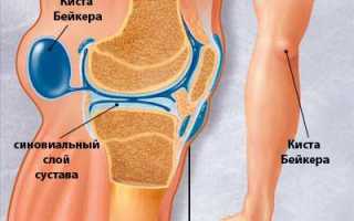 Киста Бейкера коленного сустава