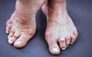 Причины и симптомы артрита суставов стопы