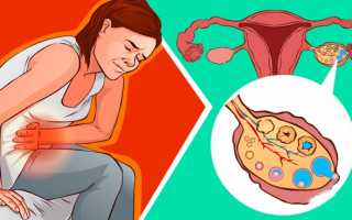 Причины боли в яичниках при задержке месячных