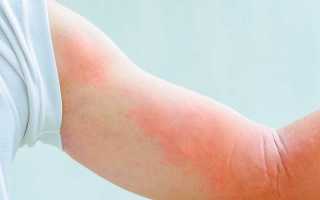 Аллергия на морских свинок: симптомы у детей и взрослых, лечение