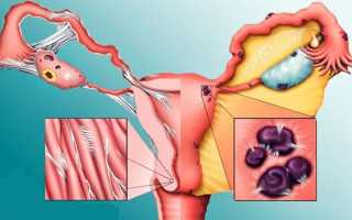 Отличия между эндометритом и эндометриозом