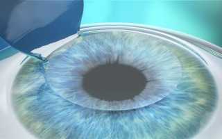Методы лазерной коррекции зрения: фемто ласик