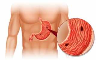 Симптомы и лечение гастропатии желудка