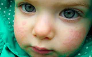 Причины и способы лечения аллергии на лице