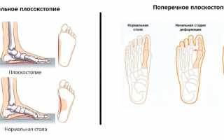 Плоскостопие: как определить и как избавиться