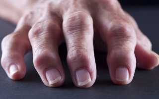 Артрит пальцев рук: диагностика и средства для лечения