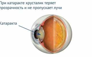 Как сохранить ясный взгляд: существует ли профилактика катаракты?