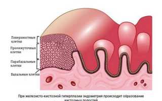 Признаки, симптомы и лечение гиперпластического процесса эндометрия
