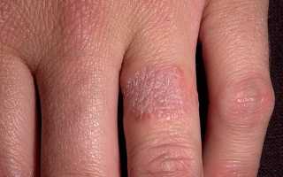 Аллергия на металл: симптомы, способы лечения