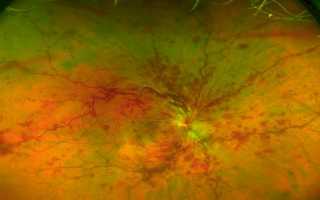 Как распознать инсульт глаза: первые симптомы и признаки