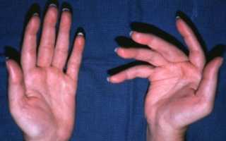 Причины и симптомы полиартрита пальцев рук