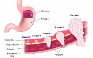 Лечится ли рак желудка?