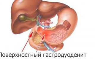 Осложнения и лечение поверхностного гастродуоденита