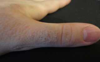 Как лечить аллергию на руках