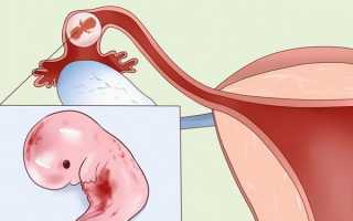 Опасные последствия невылеченного эндометриоза матки