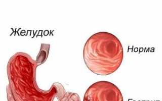 Что такое дуоденит желудка?