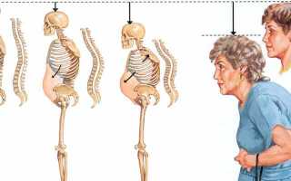 Симптомы и диагностика остеопороза позвоночника