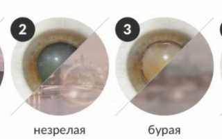 Диагноз катаракта: лечение народными средствами — 10 самых эффективных рецептов