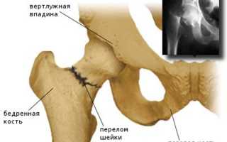 Остеопороз: что такое, признаки, причины