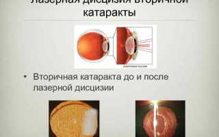 Кому проводится лазерная дисцизия вторичной катаракты?