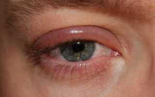 Аллергический блефарит: симптомы и лечение заболевания