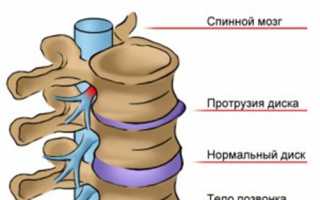 Протрузия межпозвонковых дисков поясничного отдела