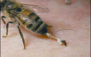 Лечение аллергии на укусы насекомых