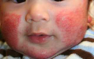 Атопический дерматит у детей и взрослых