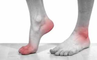 Причины и симптомы артроза ступней ног