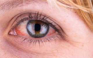 Как распознать и лечить инфекции глаз