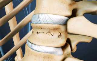 Компрессионный перелом позвоночника