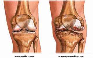 Воспаление коленного сустава: как лечить
