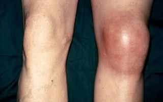Причины и симптомы гемартроза коленного сустава