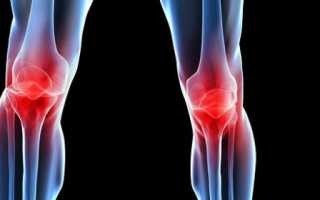 Гонартроз коленного сустава: симптомы и лечение