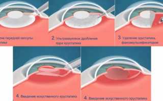 Вам поставлен диагноз катаракта? Операция — самый эффективный способ лечения