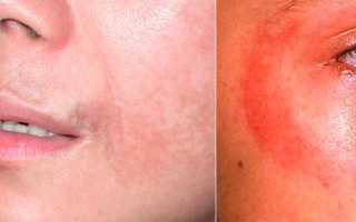 Аллергия на солнце: причины, способы лечения
