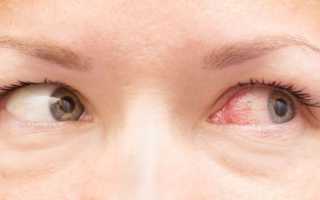 5 причин, почему повышается или понижается глазное давление