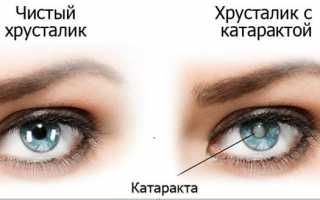 Возрастные изменения зрения: старческая катаракта