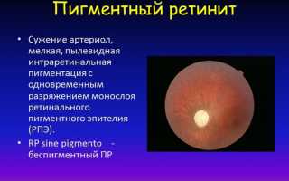 Причины пигментного ретинита, симптоматика и методы лечения