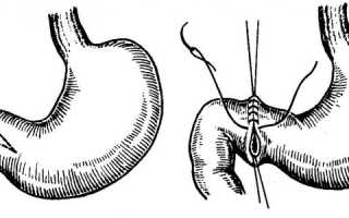 Прободение язвы желудка