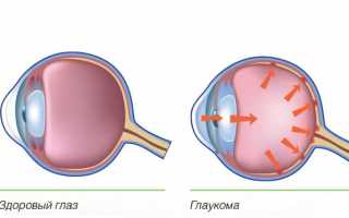 У кого может развится и чем опасна глаукома?