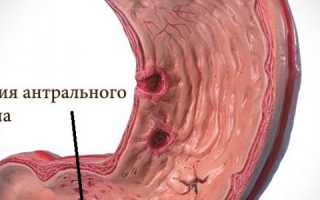 Эрозии желудка в антральном отделе