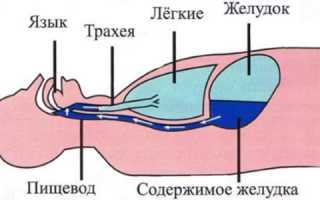 Аспирация содержимого желудка