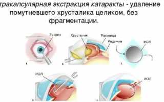Кому проводиться экстракция катаракты? Эффективна ли операция с имплонтацией ИОЛ
