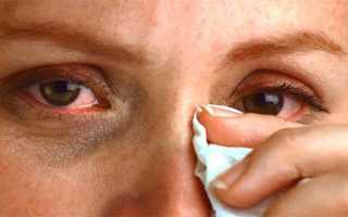 Чем лечить аллергию на веках глаз